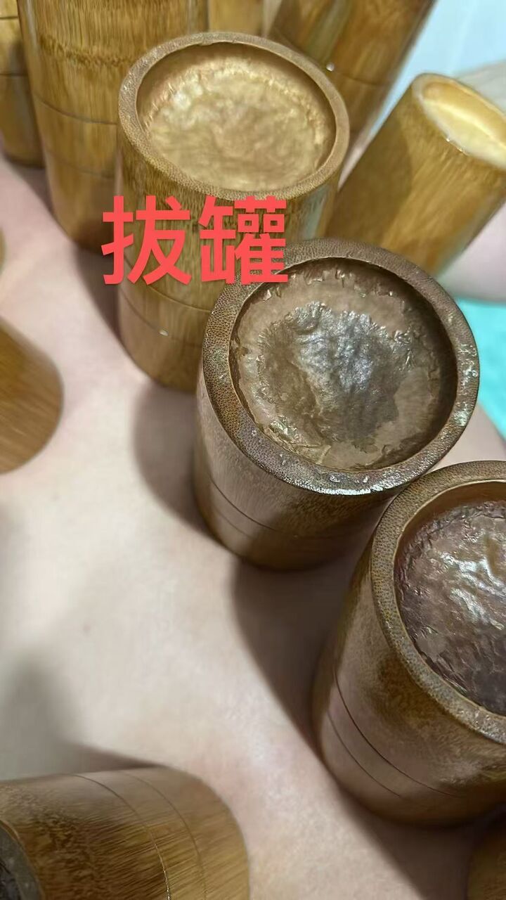 拔罐图.jpg